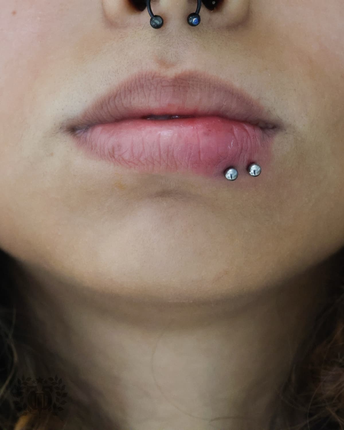 Smiley: Upper Frenulum